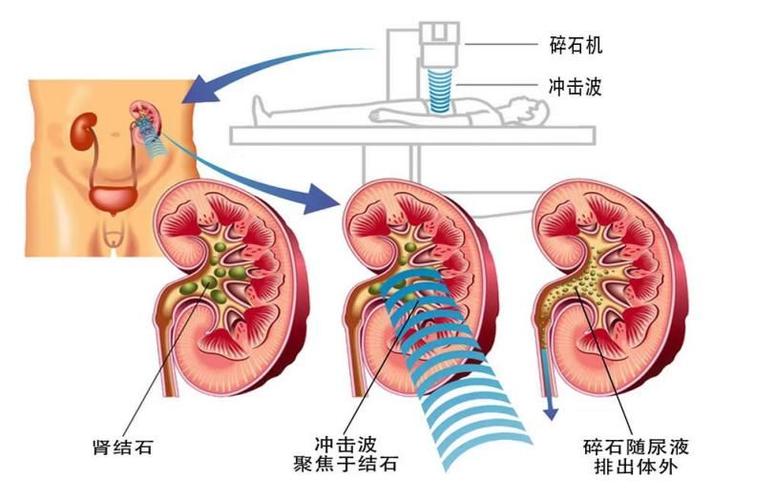 肾结石0.8cm需要手术吗