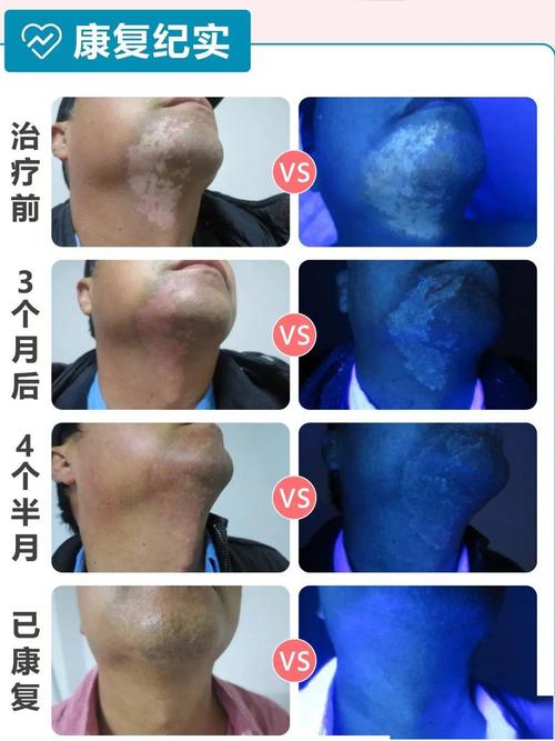 脸上出现白癜风如何治疗呢