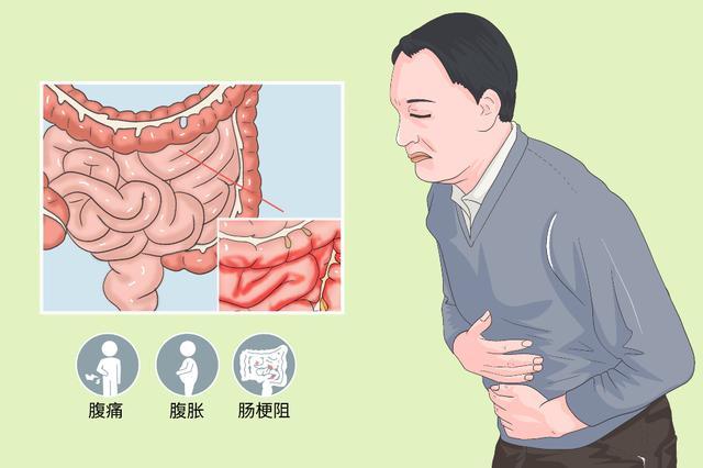 慢性肠梗阻症状疑似肠粘连