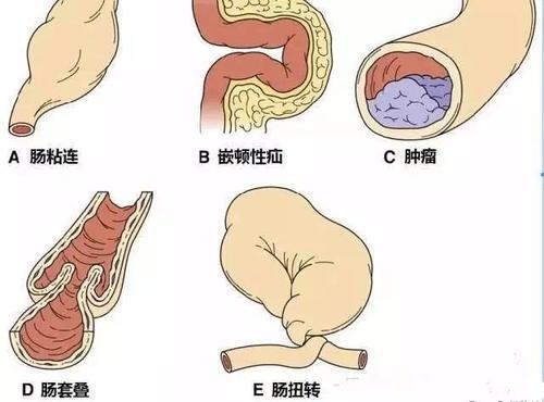 慢性肠梗阻症状疑似肠粘连