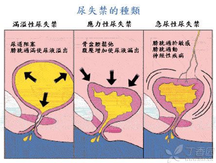 溢流性尿失禁和尿潴留的区别