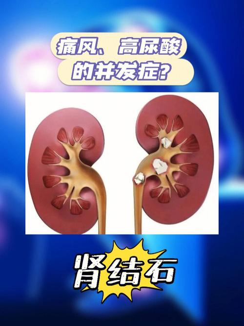 高尿酸血症合并痛风如何治疗