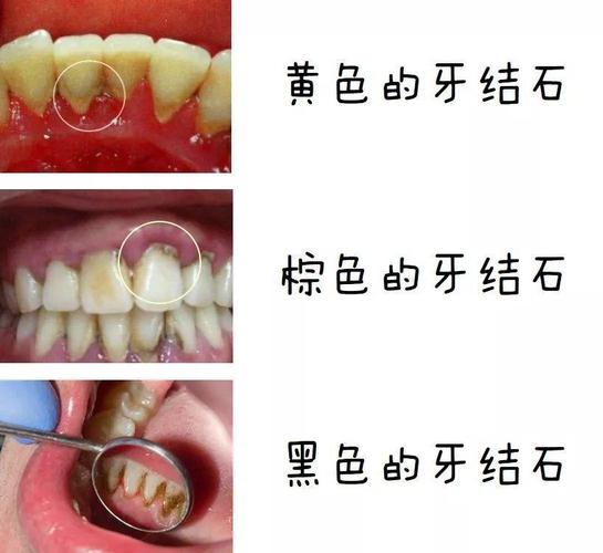 牙结石对患者的影响是什么