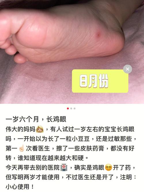 小孩子为什么有鸡眼