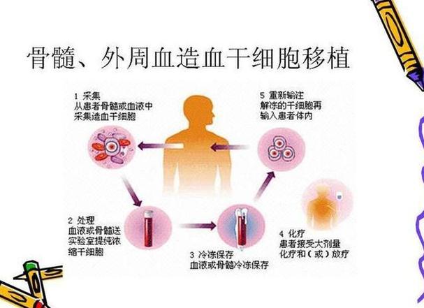 白血病异体移植后血小板低