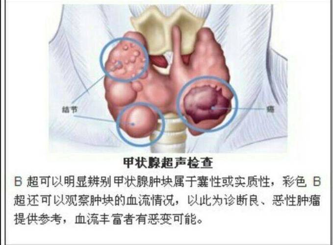 甲状腺癌单发和多发的特征