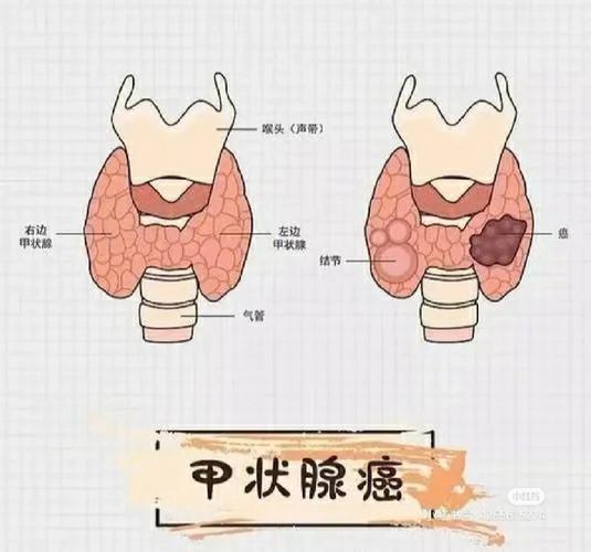 甲状腺癌不能走路吗为什么