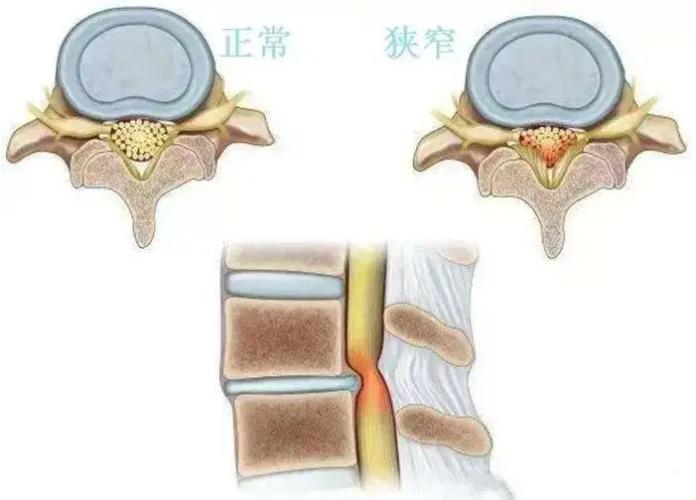 颈椎间盘突出导致椎管狭窄