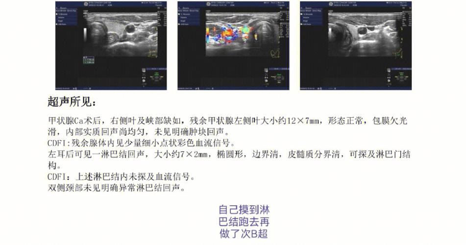 甲状腺癌半切并淋巴结转移