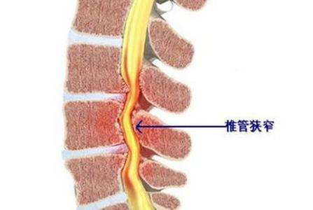 颈椎间盘突出导致椎管狭窄