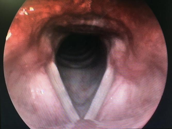 甲状腺癌导致右侧声带麻痹