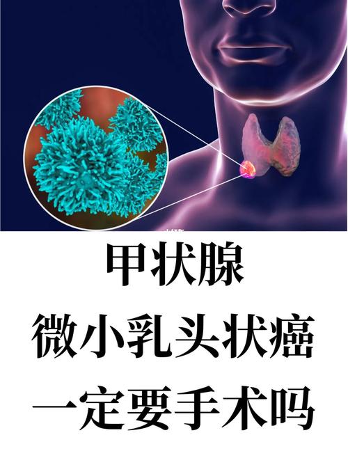 甲状腺癌患者是不是要全切