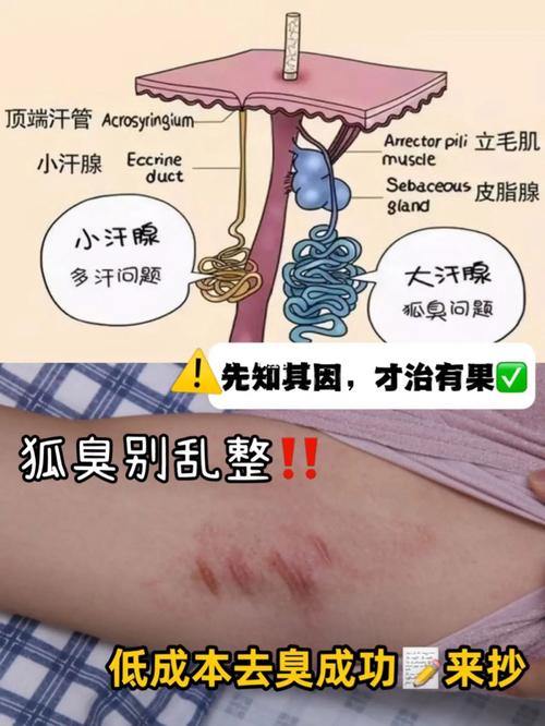 腋窝挤出水很臭狐臭