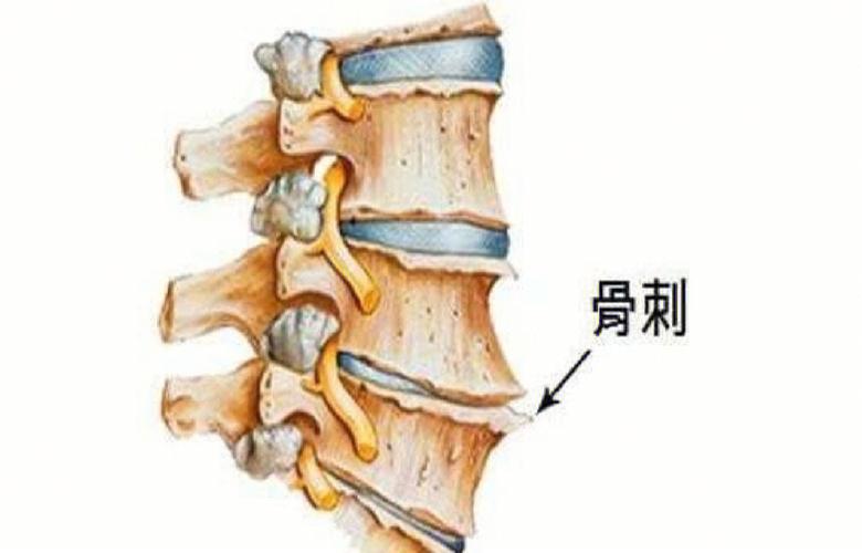 骨质增生背部脊椎痛怎么办