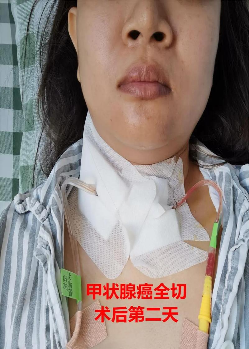 甲状腺癌不手术治疗能行吗