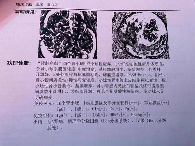 iga肾炎长期血尿的危害