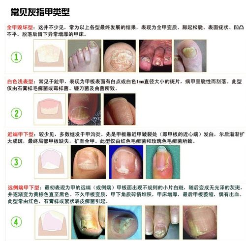 怎么看得没得灰指甲