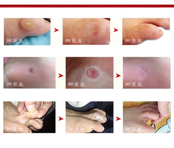 寻常疣贴鸡眼贴硬了