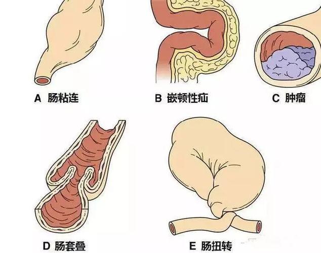 大便拉痢疾与小肠有关系吗