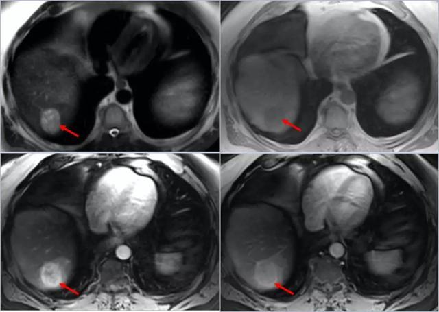 十天前核磁共振检查出肝癌