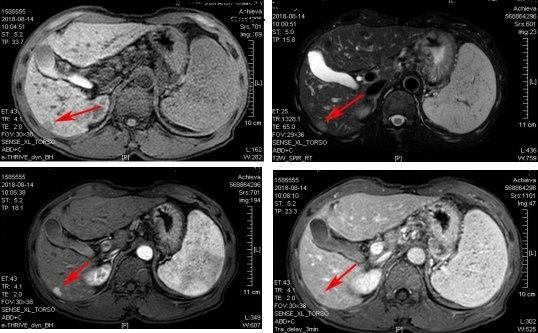 十天前核磁共振检查出肝癌