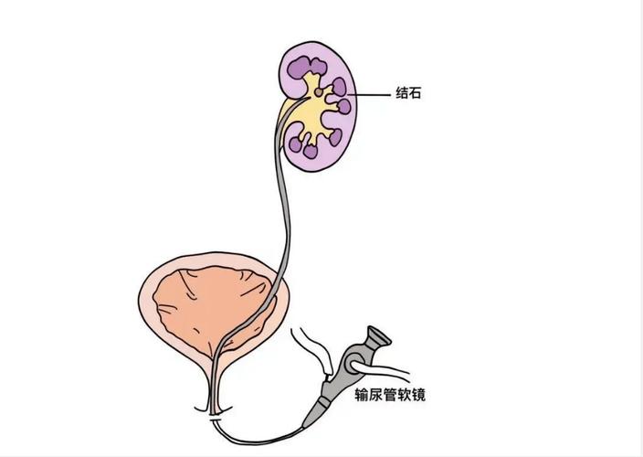 输尿管结石吃药调理可以吗