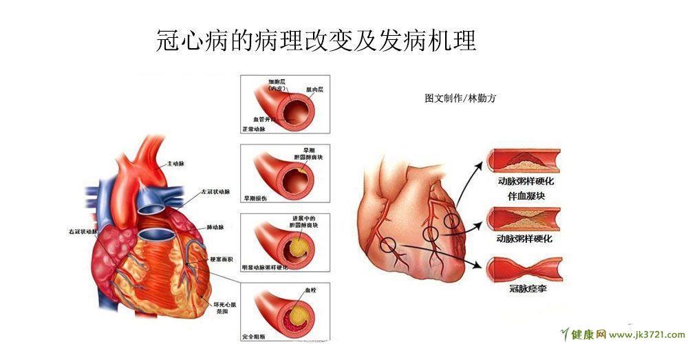 心肌缺血贫血是什么引起的