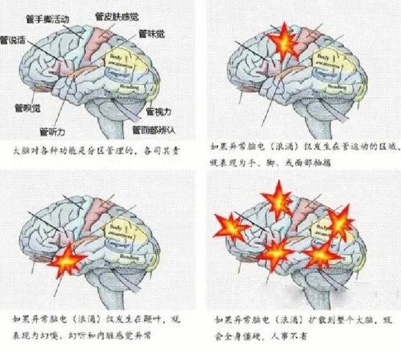 颞叶癫痫病发会出现幻觉吗