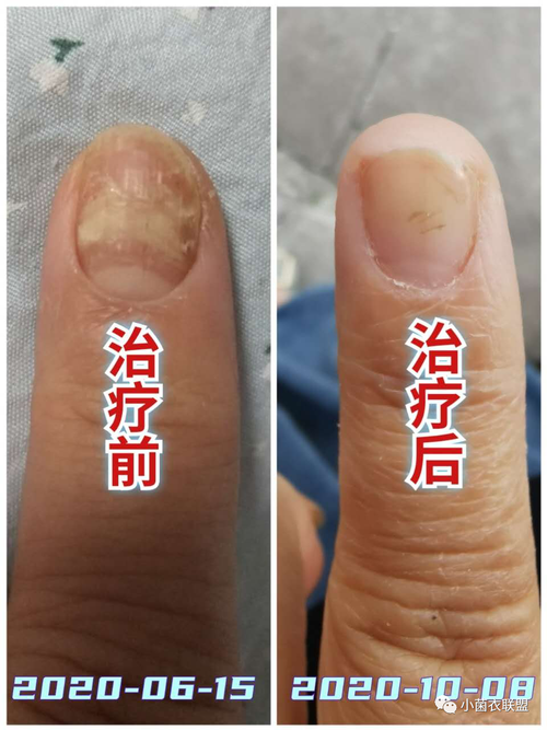 血液能治疗灰指甲吗