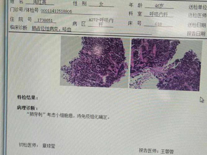 检查为小细胞肺癌晚期转移