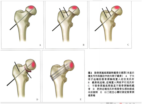 股骨坏死和肾虚有什么关系