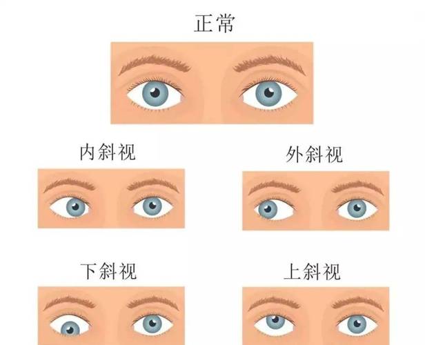 怎样判断孩子是不是内斜视