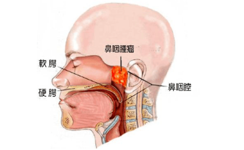 鼻癌扩散到淋巴癌能活多久