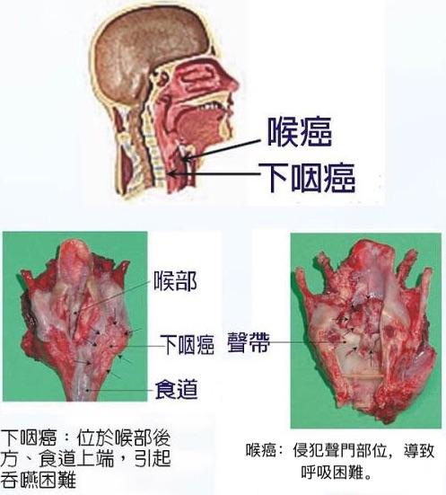 喉癌的分型有哪些