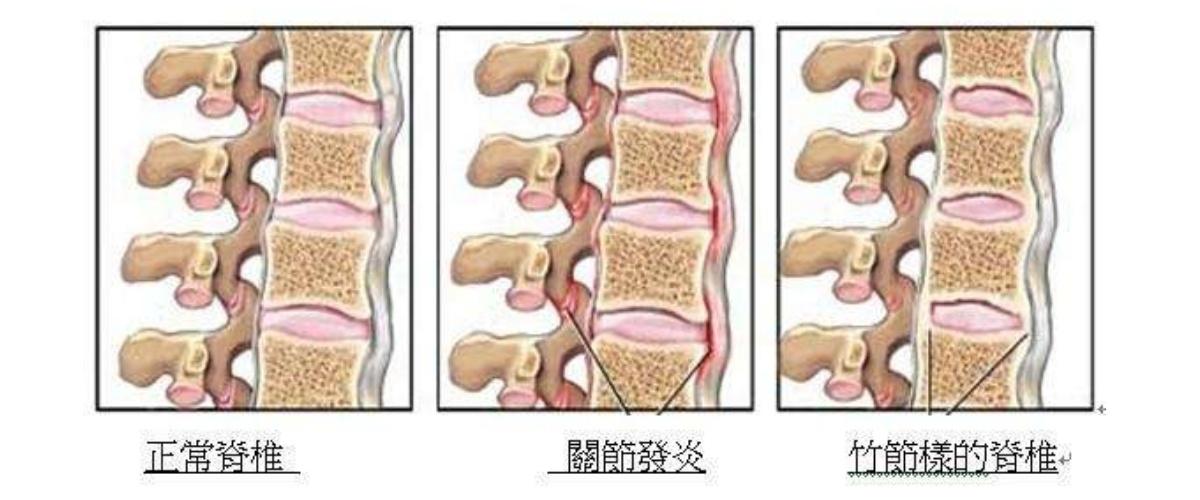 强直性脊柱炎为什么会复发