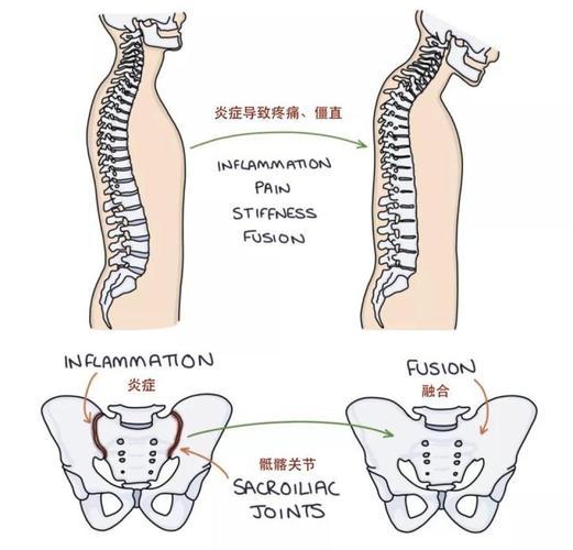 强直性脊柱炎为什么会复发