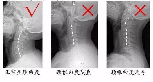 颈椎反弓椎间盘突出是肾虚