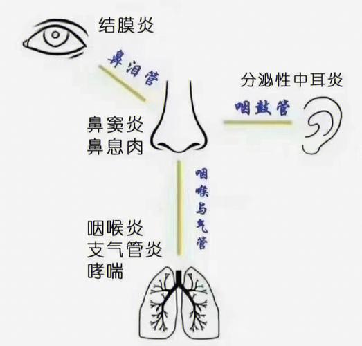 鼻炎咽炎会引起耳朵发炎吗