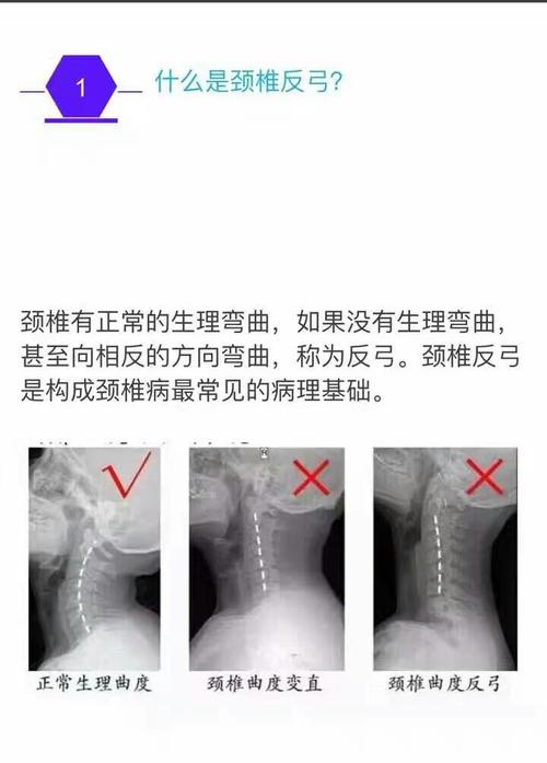 颈椎反弓椎间盘突出是肾虚