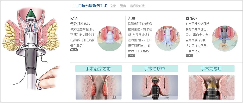 传统痔疮手术和pph优劣