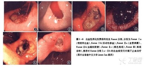 多处胃溃疡便血怎么办啊