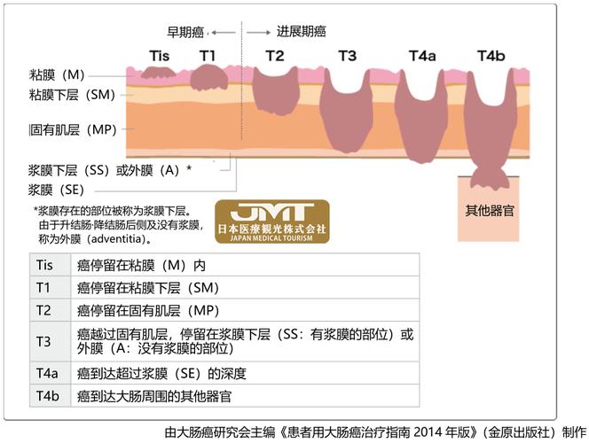 管状腺瘤一级直肠癌进展期