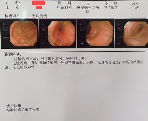 消瘦治疗检查中发生肠梗阻