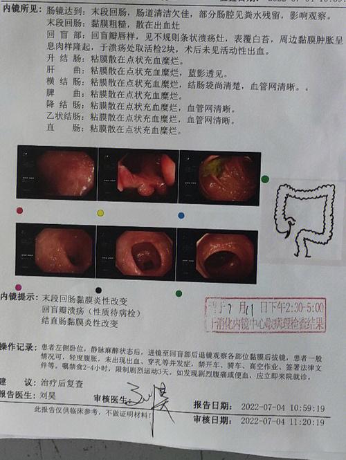 消瘦治疗检查中发生肠梗阻