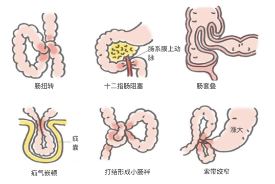 术后肠梗阻是怎样形成的