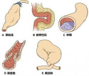 术后肠梗阻是怎样形成的