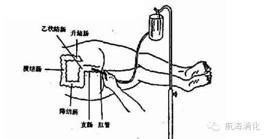 术后肠梗阻是怎样形成的