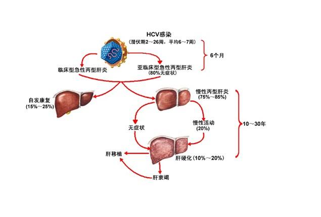 得丙型肝炎会怎样治疗吗