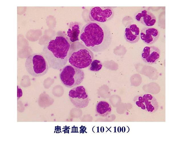 白血病中性粒细胞怎么样