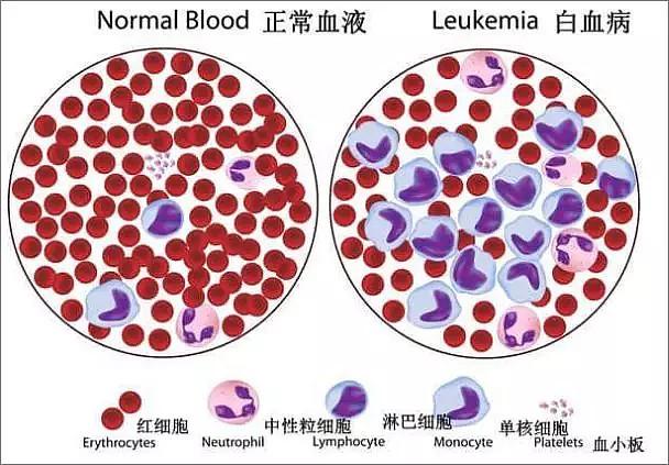 白血病中性粒细胞怎么样